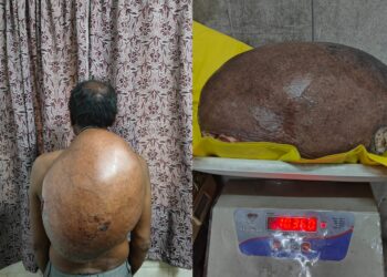 10.30 किलो का ट्यूमर सफलतापूर्वक निकाला, मरीज को मिली नई जिंदगी