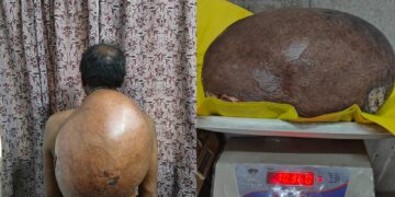 10.30 किलो का ट्यूमर सफलतापूर्वक निकाला, मरीज को मिली नई जिंदगी