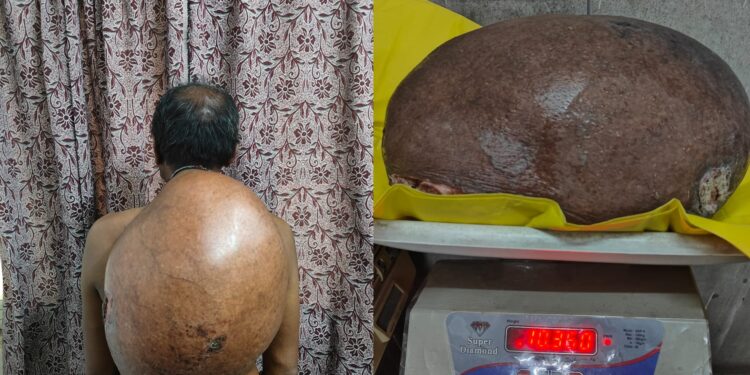 10.30 किलो का ट्यूमर सफलतापूर्वक निकाला, मरीज को मिली नई जिंदगी