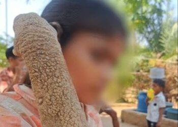दुर्लभ बीमारी से जूझ रही 14 साल की बच्ची की त्वचा में सुधार, 55 दिन के इलाज का दिखा असर