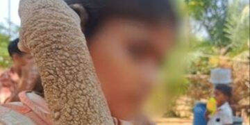 दुर्लभ बीमारी से जूझ रही 14 साल की बच्ची की त्वचा में सुधार, 55 दिन के इलाज का दिखा असर