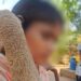 दुर्लभ बीमारी से जूझ रही 14 साल की बच्ची की त्वचा में सुधार, 55 दिन के इलाज का दिखा असर